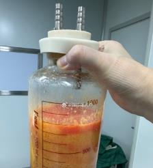 石河子水动力吸脂手术要做多久？